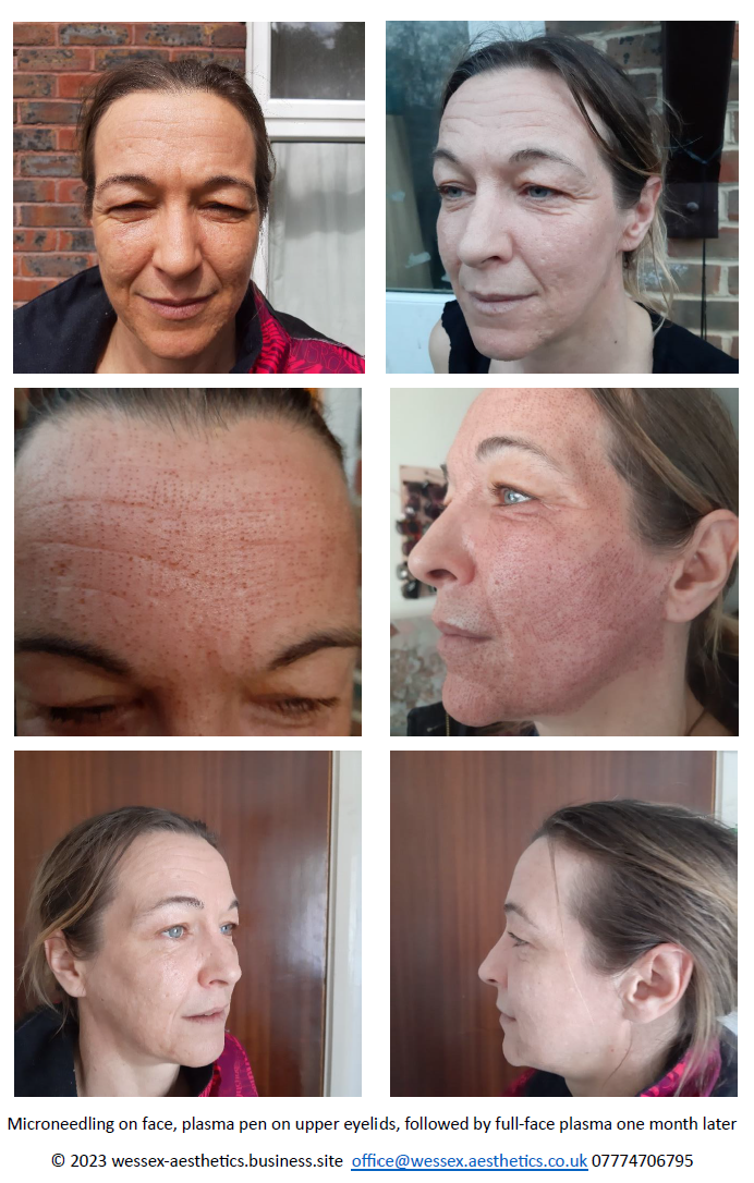 before after plasma pen treatment on face 07774706795 wessex aesthetics.business.site email office@wessex.aesthetics.co .uk